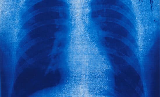 Les Levine, Chest X-Ray, from the Toronto 20 Portfolio, 1965, silkscreen on acetate, ed. 73/100. Purchased with the assistance of the Ministry of Citizenship and Culture through a Wintario Grant, 1983.